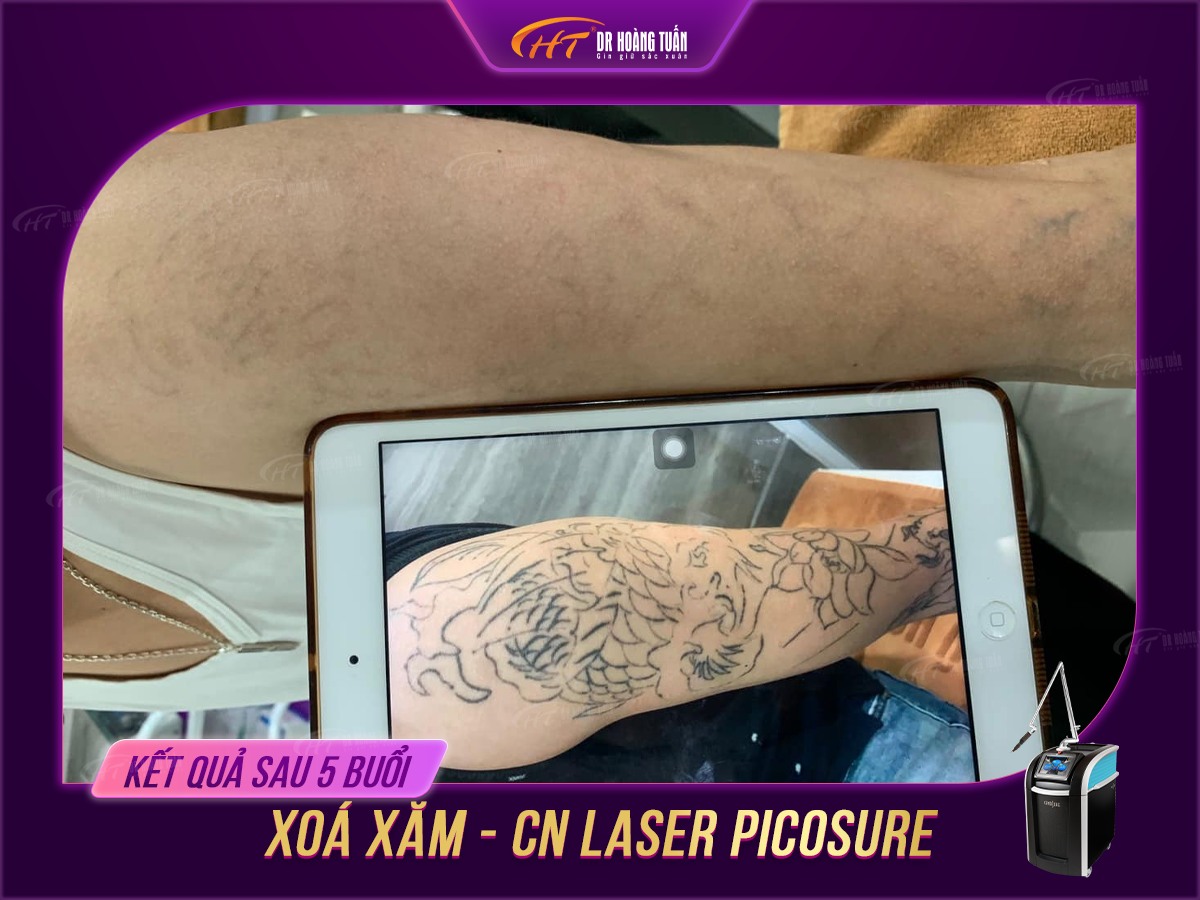 hình ảnh sau khi xóa xăm